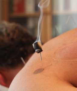Acupuncture Treatments in Manning Perth